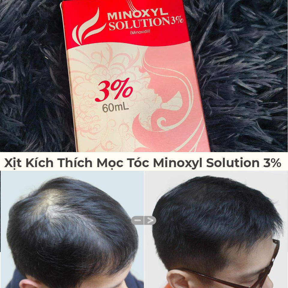 Xịt Kích Thích Mọc Tóc Minoxyl Solution 3% Hỗ Trợ Điều Trị Rụng Tóc Và Hói-1